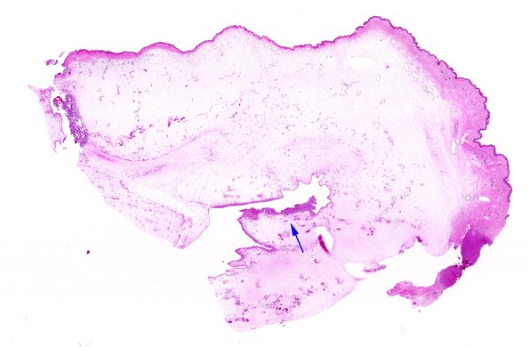 25B1 Encephalocoele (Case 25) H&E WM 2 copy