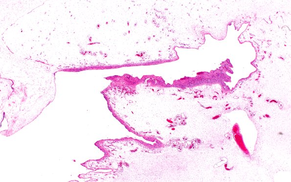 25B2 Encephalocoele (Case 25) A4 H&E 2X