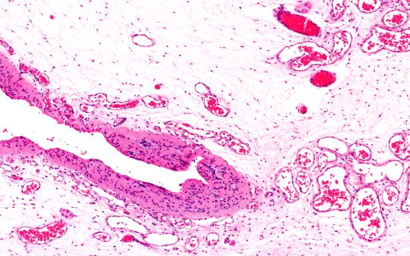 25B3 Encephalocoele (Case 25) H&E 10X