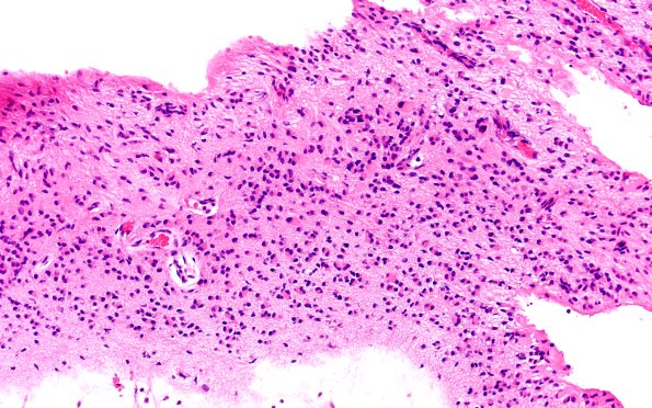 25B4-Encephalocoele-Case-25-A4-H-E-20X