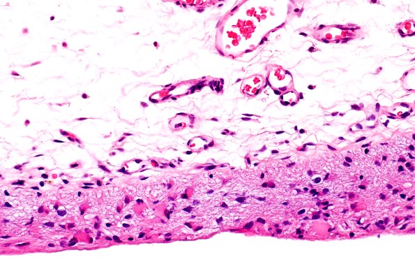 25B5-Encephalocoele-Case-25-A4-H-E-40X