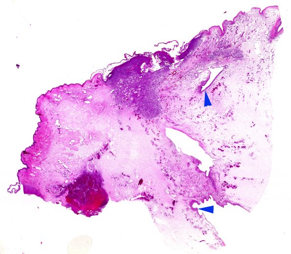 25B6-Encephalocoele-Case-25-H-E-WM-copy