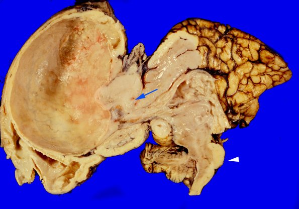 26A-Encephalocoele-Case-26-copy