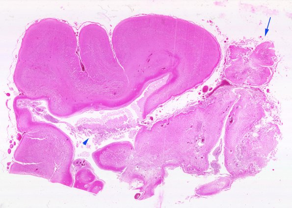 26B-Encephalocoele-Case-26-H-H-E-WM-copy