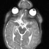 29A2-Encephalocoele-Case-29-T2-HASTE-3-Copy