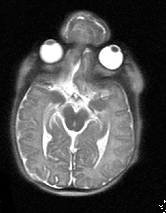 29A2-Encephalocoele-Case-29-T2-HASTE-3-Copy