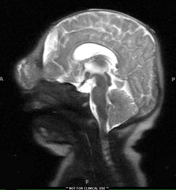 29A3-Encephalocoele-Case-29-T2-HASTE-4-Copy-2-