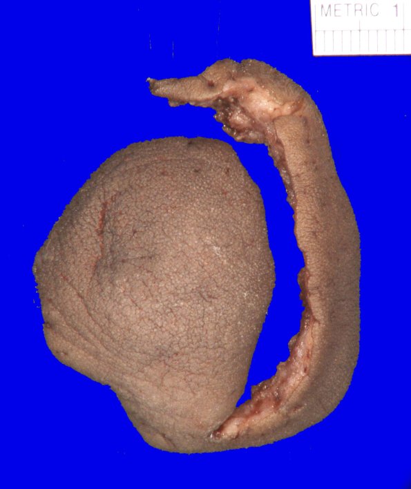 29C1-Encephalocoele-Case-29-_1