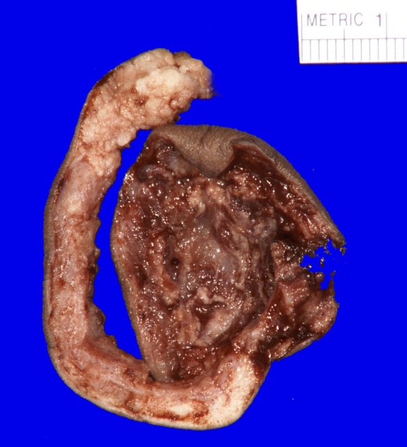 29C2-Encephalocoele-Case-29-_2