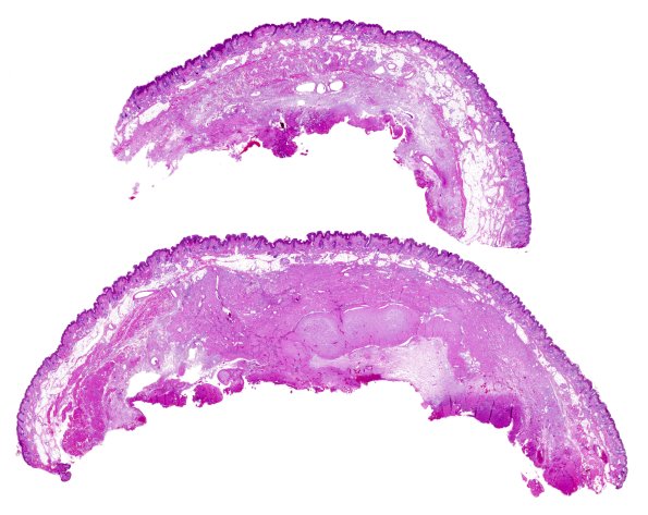 29D1-Encephalocoele-Case-29-H-E-A9-whole-mount