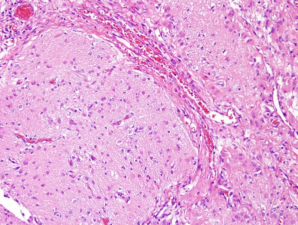 29D4-Encephalocoele-Case-29-A8-H-E-13.jpg