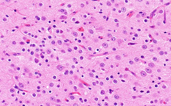 29D5 Encephalocoele (Case 29) A8 H&E 40X