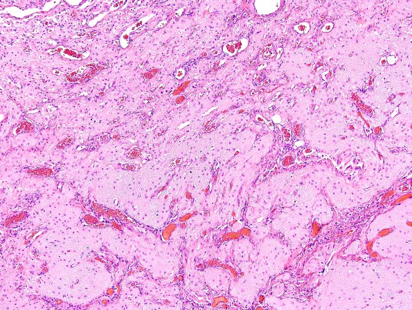 29D7-Encephalocoele-Case-29-A8-H-E-7.jpg