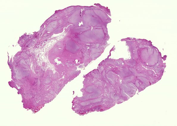 29D8 Encephalocoele (Case 29) H&E A8 whole moun