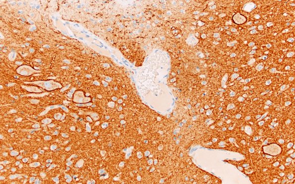 29E3 Encephalocoele (Case 29) A8 SYN 40X 5