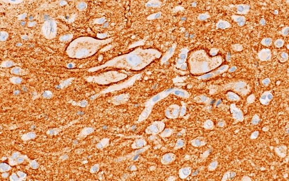 29E4 Encephalocoele (Case 29) A8 SYN 40X 4