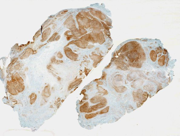 29F1-Encephalocoele-Case-29-NF-whole-mount