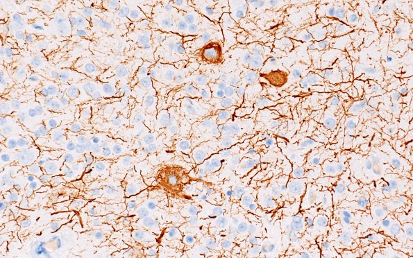 29F5 Encephalocoele (Case 29) A8 NF 40X 2