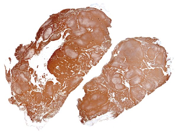 29G1 Encephalocoele (Case 29) GFAP whole mount