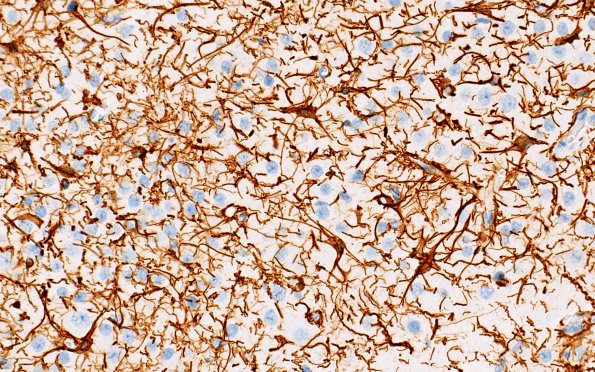 29G4-Encephalocoele-Case-29-A8-GFAP-40X-5