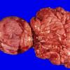 2A2 Encephalocoele (Case 2) 4