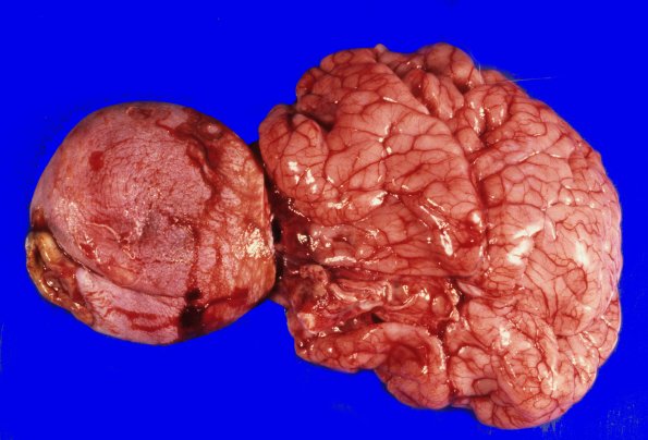 2A2 Encephalocoele (Case 2) 4