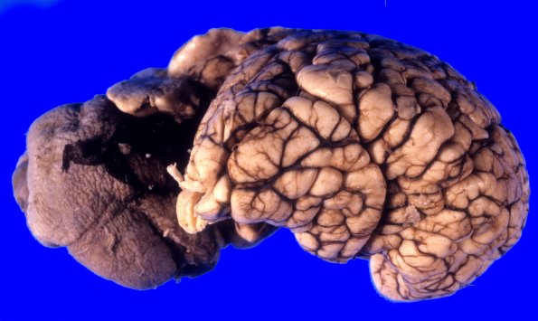 2A3-Encephalocele-Case-2-3