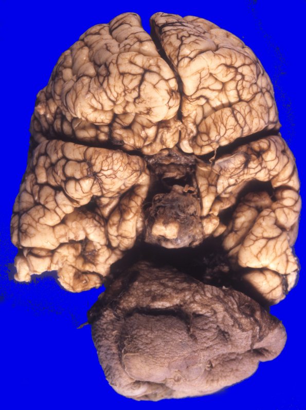2A4 Encephalocele (Case 2) 4