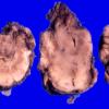 2A7 Encephalocele (Case 2) 2 (contents)