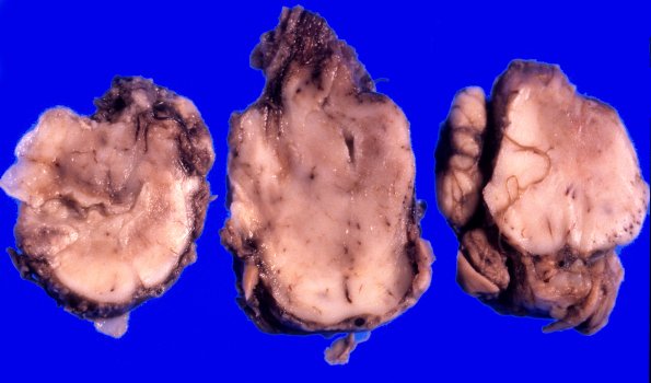 2A7 Encephalocele (Case 2) 2 (contents)