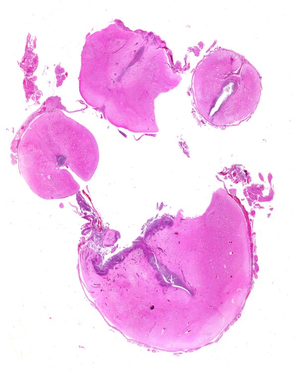 2B1 Encephalocoele (Case 2) H&E N10 WM