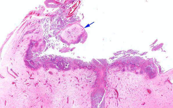 2B2 Encephalocoele (Case 2) H&E N10 2X copy