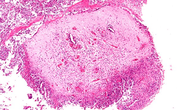 2B3 Encephalocoele (Case 2) H&E N10 10X