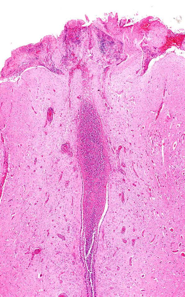 2B4 Encephalocoele (Case 2) H&E N10 10X