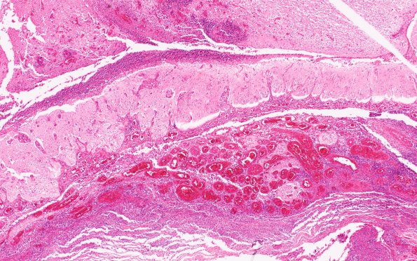 2B5 Encephalocoele (Case 2) H&E N11 4X