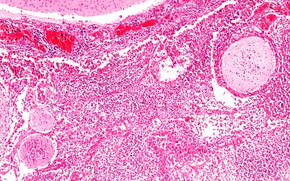 2B6 Encephalocoele (Case 2) H&E N7 10X