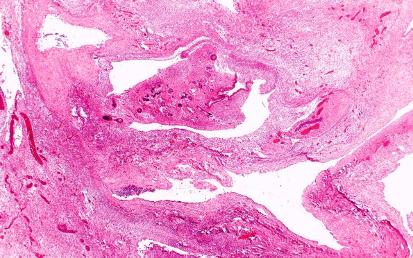 30B2 (Case 30) _2X EMH A