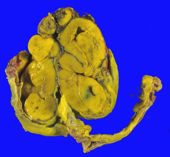 31A1 Encephalocele (Case 31) 1