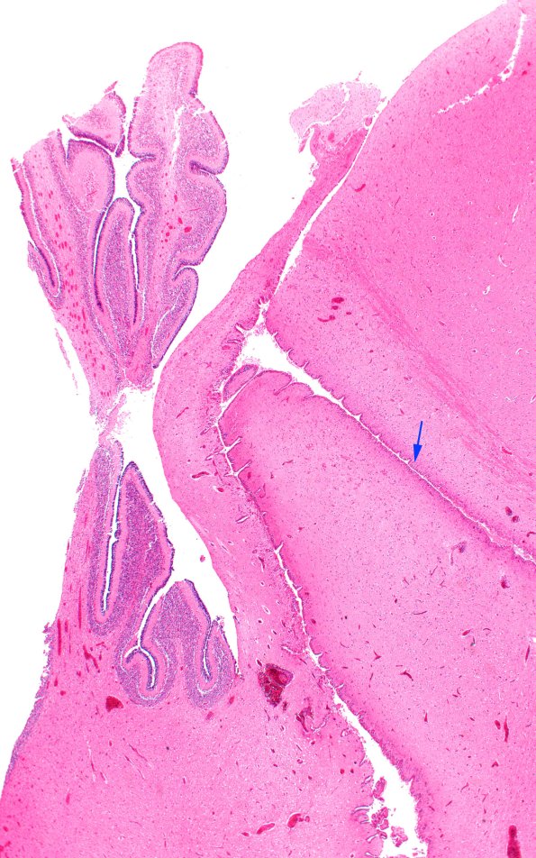 31B4 (Case 31) N5 H&E 2X copy