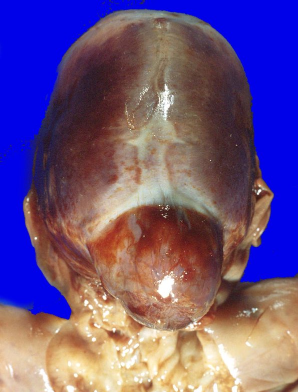 3A2 Encephalocoele 1