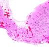 3B1 Encephalocoele (AWUMS Case) Dysplastic Brain 1