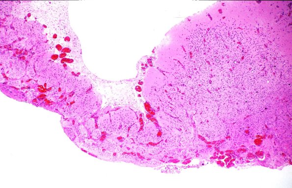 3B1-Encephalocoele-AWUMS-Case-Dysplastic-Brain-1