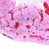 3B2 Encephalocoele (AWUMS Case) Dysplastic Brain 2