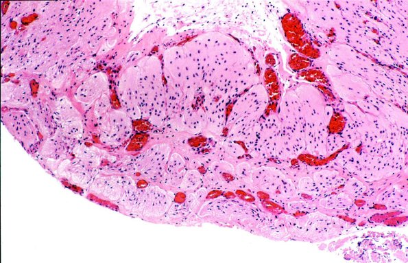 3B2 Encephalocoele (AWUMS Case) Dysplastic Brain 2