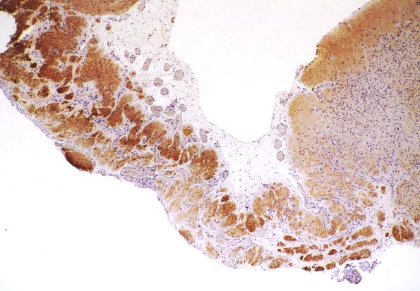 3C Encephalocoele (AWUMS Case) Dysplastic Brain GFAP 1