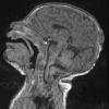 4A Encephalocele (Case 4) T1 - Copy