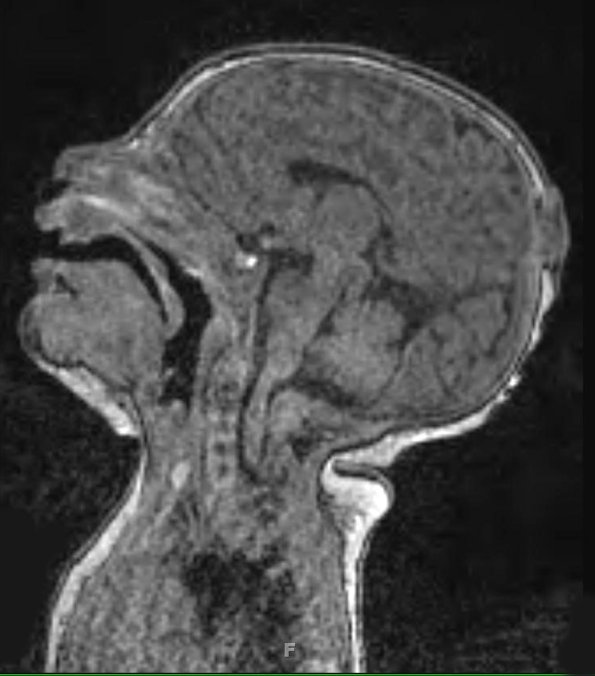 4A Encephalocele (Case 4) T1 - Copy