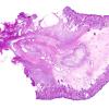 4B1 Encephalocele (Case 4) H&E whole mount