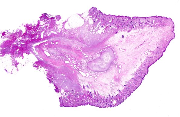 4B1-Encephalocele-Case-4-H-E-whole-mount