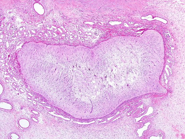 4B2-Encephalocele-Case-4-H-E-2